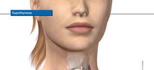 Der Kloß im Hals, Schilddrüsenunterfunktion