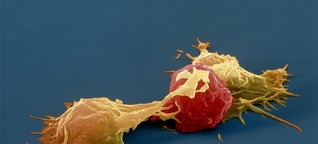 Mit eigenen Immunzellen den Krebs bekämpfen