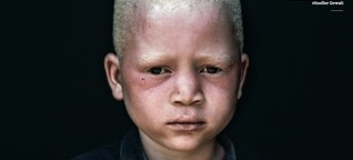 Gejagt – Menschen mit Albinismus in Zentralafrika