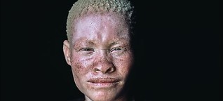 Jagd auf Menschen mit Albinismus in Malawi: "Den Gräueltaten ein Ende setzen" 