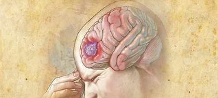 Brain Tumor: Symptoms, Diagnosis & Treatment [1]