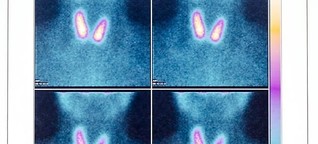 What Is Thyroid Scintigraphy? How Is It Performed?