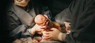 Fast jedes dritte Kind in Deutschland kommt per Kaiserschnitt zur Welt
