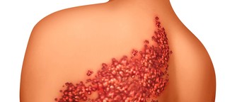 Bei einer Gürtelrose ist immer nur eine Hautpartie befallen - warum?