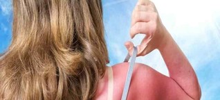 13 Effective Home Remedies To Lighten Sunburn Skin