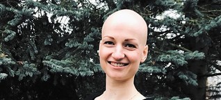 Alopecia: "Bis heute habe ich Schwierigkeiten, mit Glatze rauszugehen"
